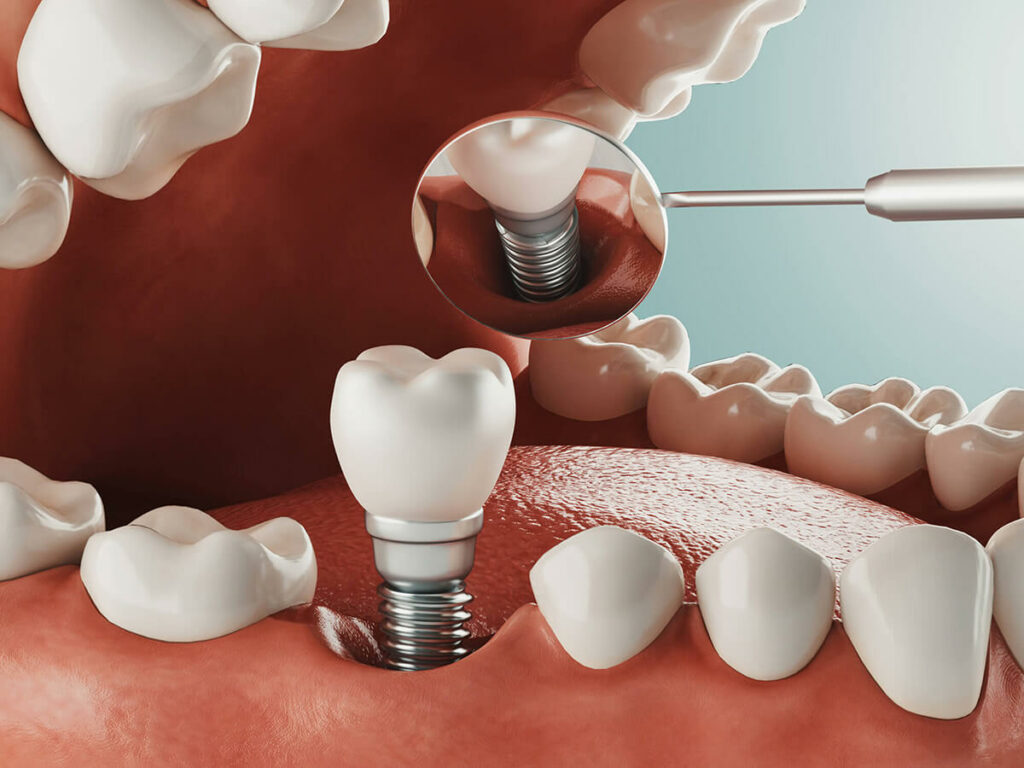 illustration of dental implant being place in mouth