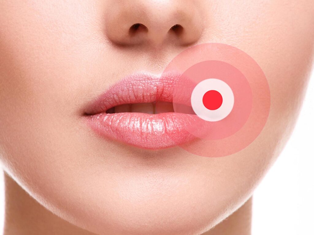 women with cold sore on mouth