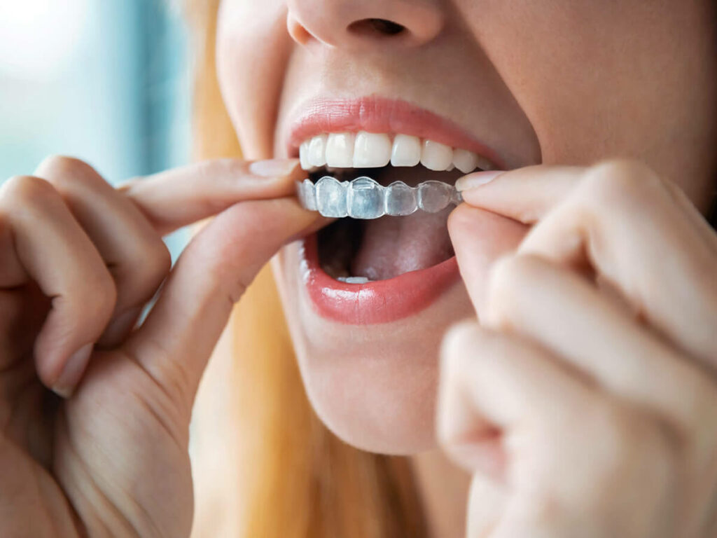 picture of woman putting invisalign aligners in mouth
