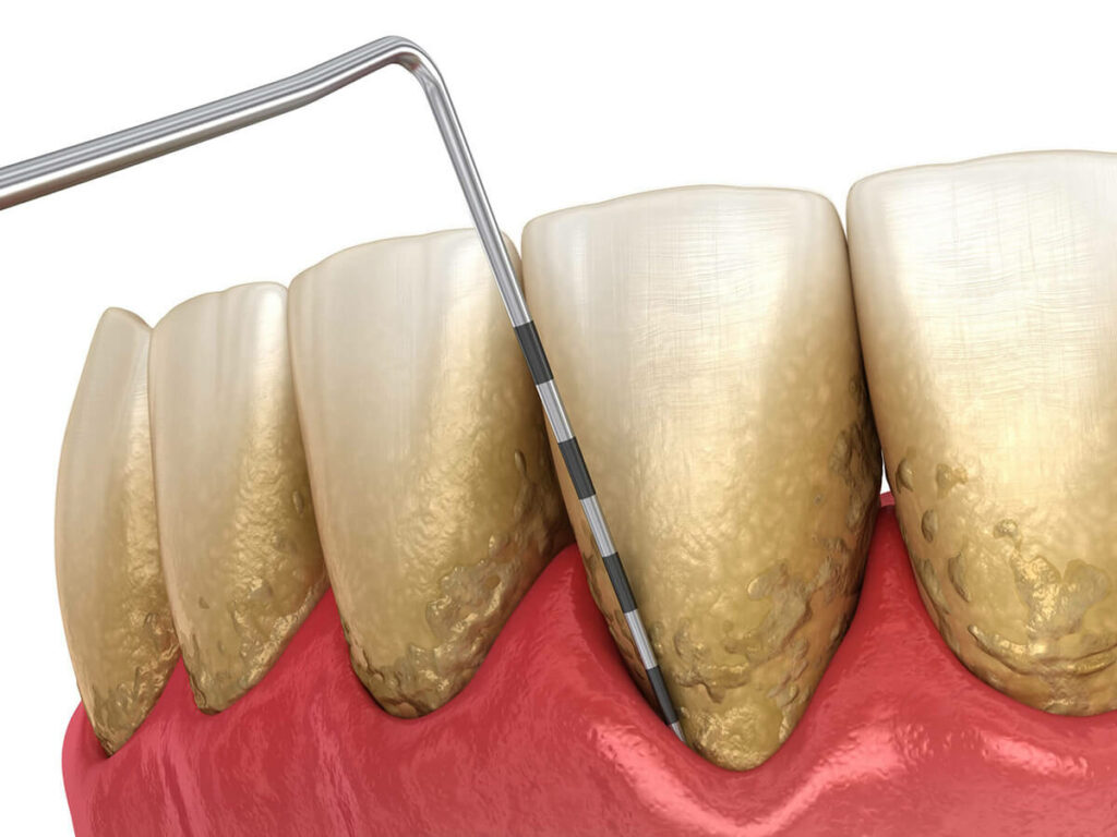 illustration of gum disease