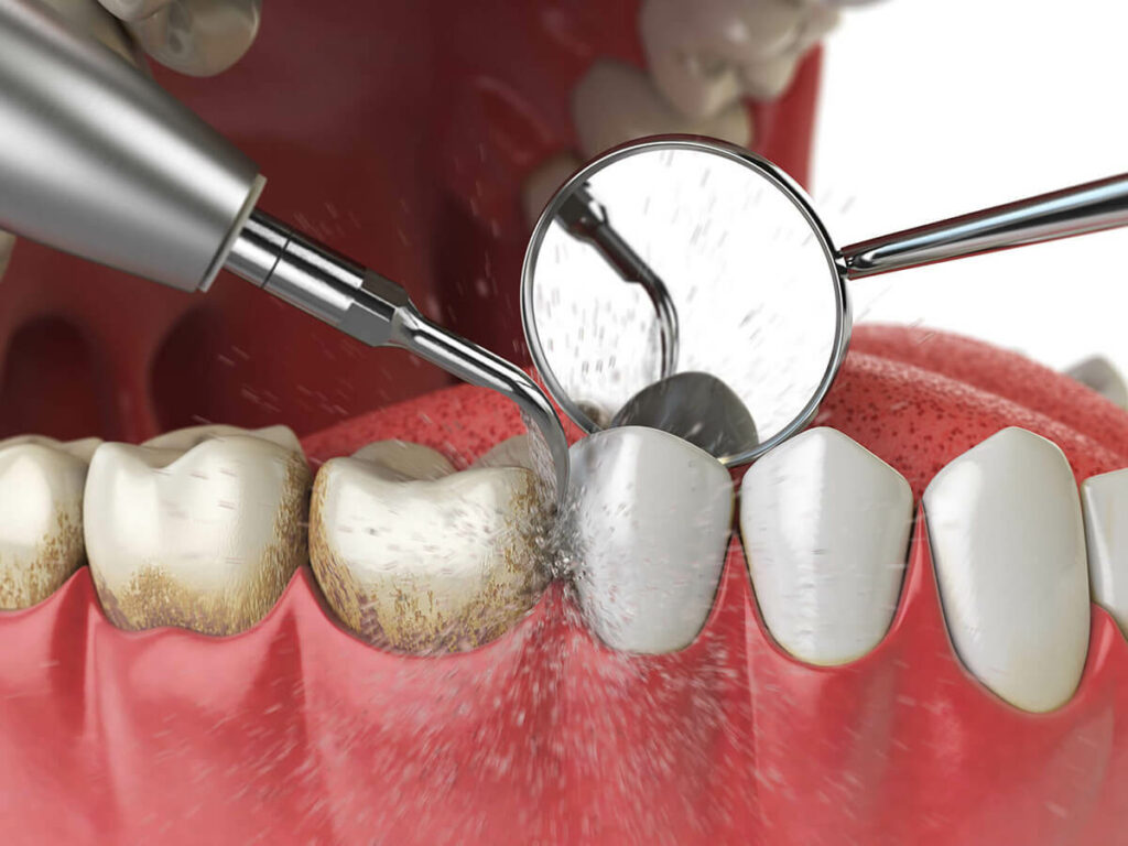 illustration of teeth being cleaned using dental tools