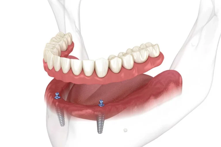 Dental Implant Snap on Dentures Illustration